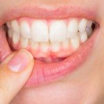 devitalizing paste in dentistry