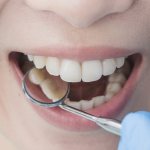 Диагностика пульпита зуба