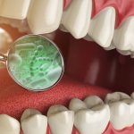 Dysbacteriosis of the oral cavity