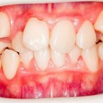 Дистопия зуба