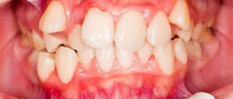 Дистопия зуба