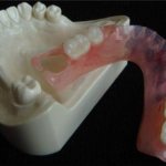 Достоинства и недостатки зубных протезов Flexite