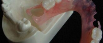 Достоинства и недостатки зубных протезов Flexite