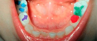 Holes in baby teeth at 3 years old