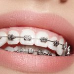 aligners after braces