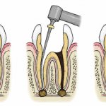 Elastic material seals tooth cavities well