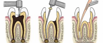 Эластичный материал хорошо герметизирует полости зуба