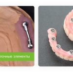 elements of removable dentures on implants