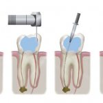 Endodontic root canal treatment