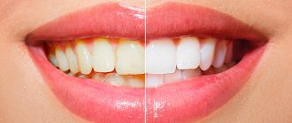 Endodontic teeth whitening