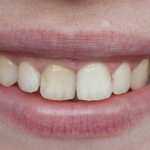 If you notice that the tooth has darkened, then it’s time to consult an endodontist. Especially if you plan to correct your bite using aligners or braces. 
