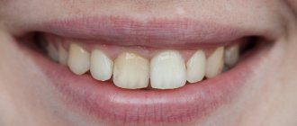 Если обратили внимание что зуб потемнел - то самое время обратиться к врачу эндодонтисту. Особенно если планируете исправлять прикус на элайнерах или брекетах.