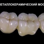 Если в боковой зоне челюсти недостает двух и более зубов, идеальный метод установки коронок – это создание моста на жевательные зубы