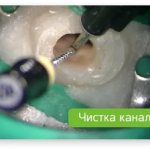 этапы депульпирования зуба перед протезированием