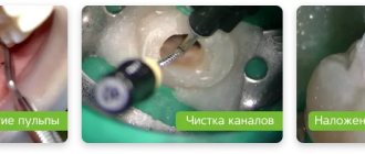 этапы депульпирования зуба перед протезированием