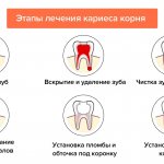 Stages of treatment of root caries in pictures