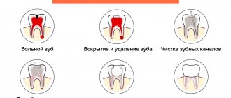 Stages of treatment of root caries in pictures