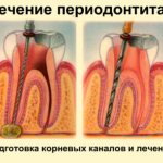 Stages of root canal treatment for dental periodontitis