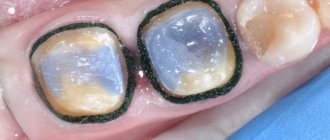 Этапы постановки ретракционной нити в стоматологии