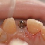 Factors for successful implantation - Line of Smile Dentistry