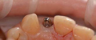 Factors for successful implantation - Line of Smile Dentistry