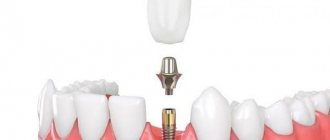 Fixation of abutment and crown