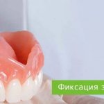 фиксация зубных протезов