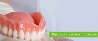 фиксация зубных протезов