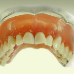 Фиксирующие зубные протезы