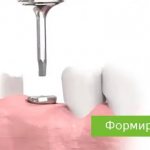 gum former for implantation