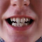 Формы сужения зубных рядов