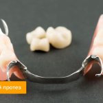 Photo of a clasp prosthesis