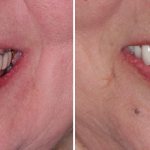 фото до и после протезирования зубов в Диал-Дент