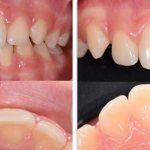 Photos before and after restoration of an injured tooth