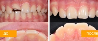 Photos before and after restoration of an injured tooth