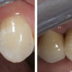 Photos before and after installation of an implant with a zirconium dioxide crown