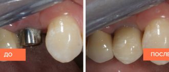 Photos before and after installation of an implant with a zirconium dioxide crown