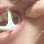 Photo: floss stuck between teeth