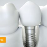 Photo of a dental implant