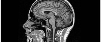 Photo MRI of the brain