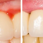 Photo of the patient before and after treatment for gingivitis