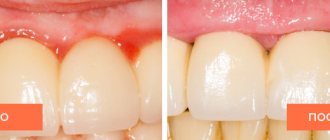 Photo of the patient before and after treatment for gingivitis