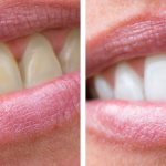 Photo of the patient before and after whitening