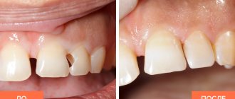 Photo of the patient before and after dental filling