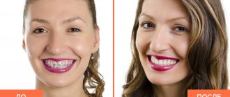 Фото пациента до и после снятия брекетов с зубов