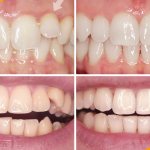 Фото пациента до и после выравнивания зубов капами