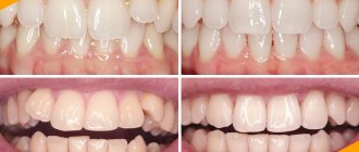 Photo of a patient before and after straightening teeth with aligners