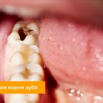 Photo of perforation of a tooth root in a patient’s mouth