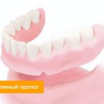Photo of a complete removable denture