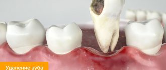 Photo of the tooth extraction process